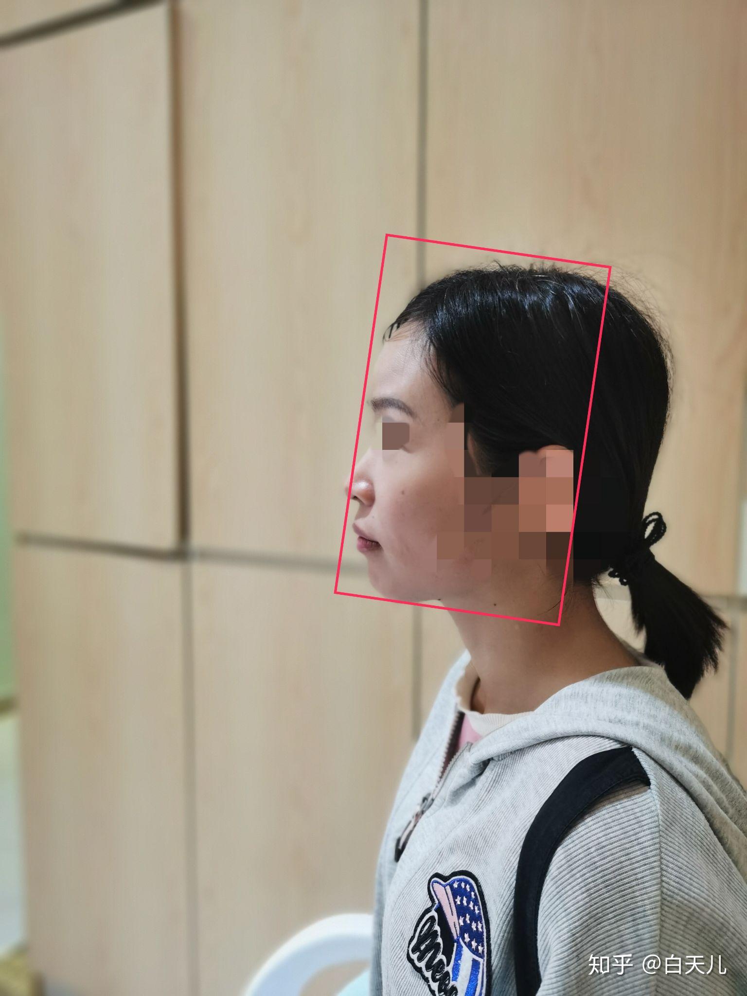 有没有没拔牙矫正后发现嘴凸然后进行二次矫正或正颌手术的