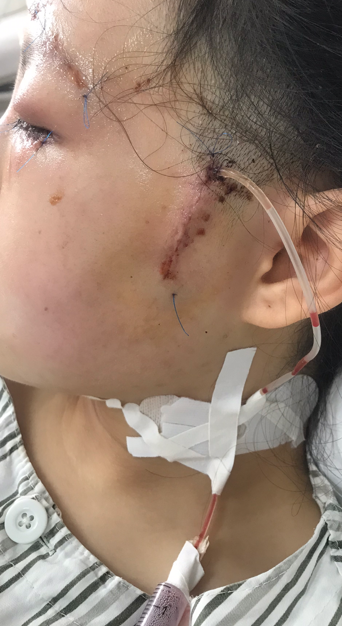 记录人生的第一次住院 颧弓骨折