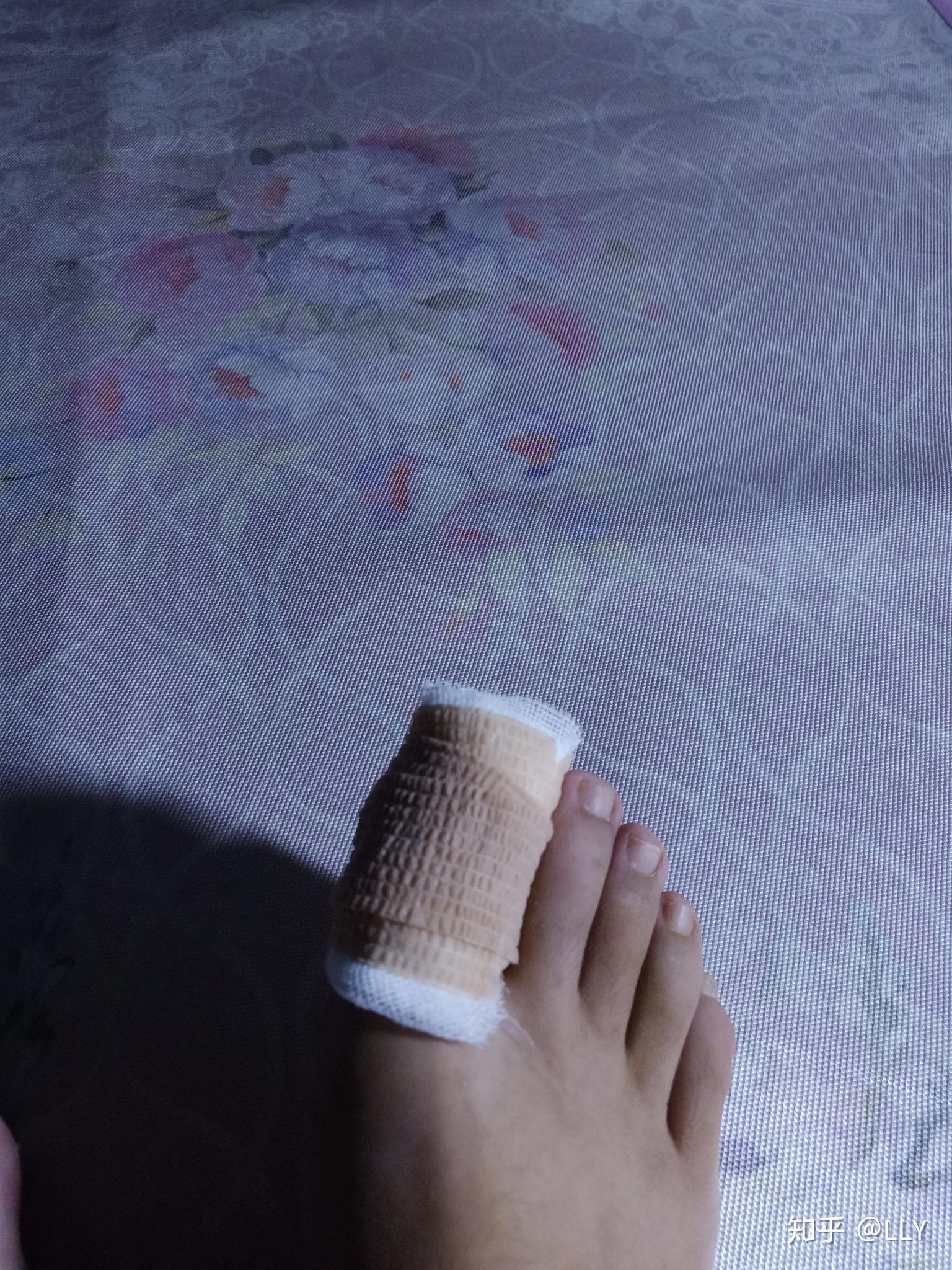 甲沟炎手术拔甲缝针后如何处理才能提前正常行走