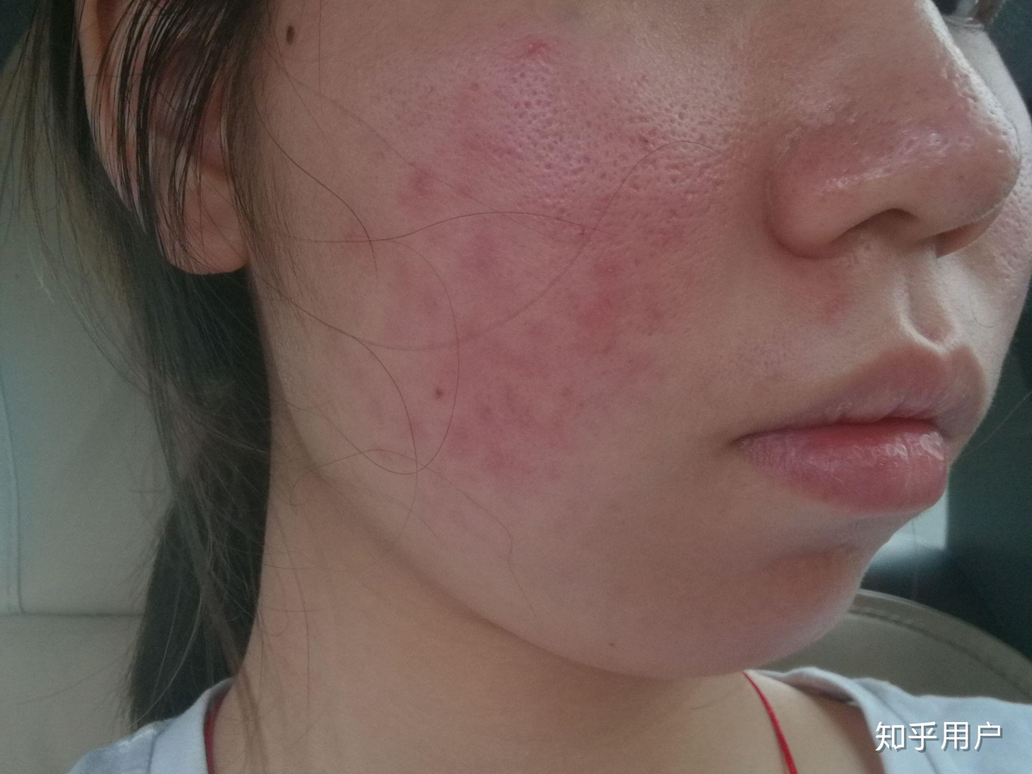 玫瑰痤疮怎么治? - 知乎
