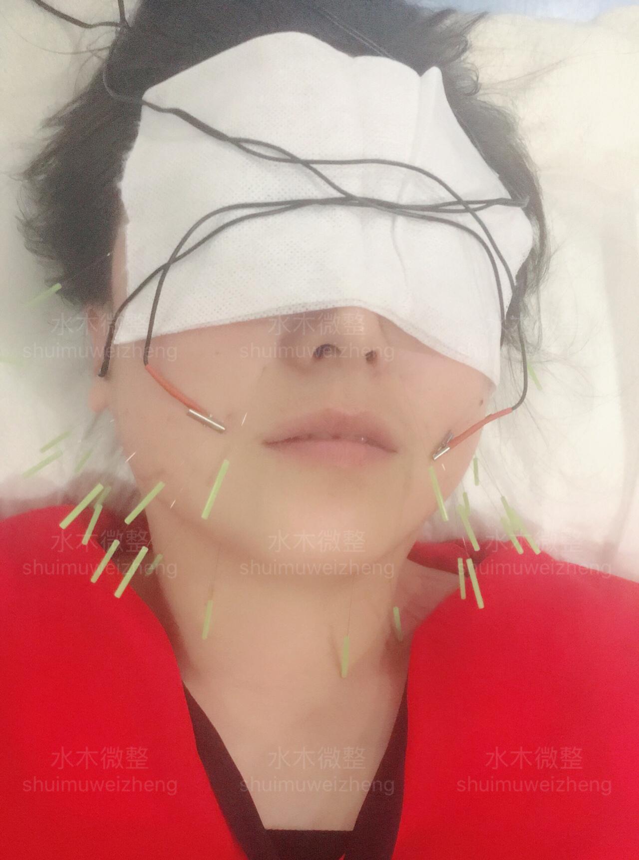啥是美容针 v2-ecc58503bd903cc7b981b2735efe4346_1440w.jpg?source=172ae18b