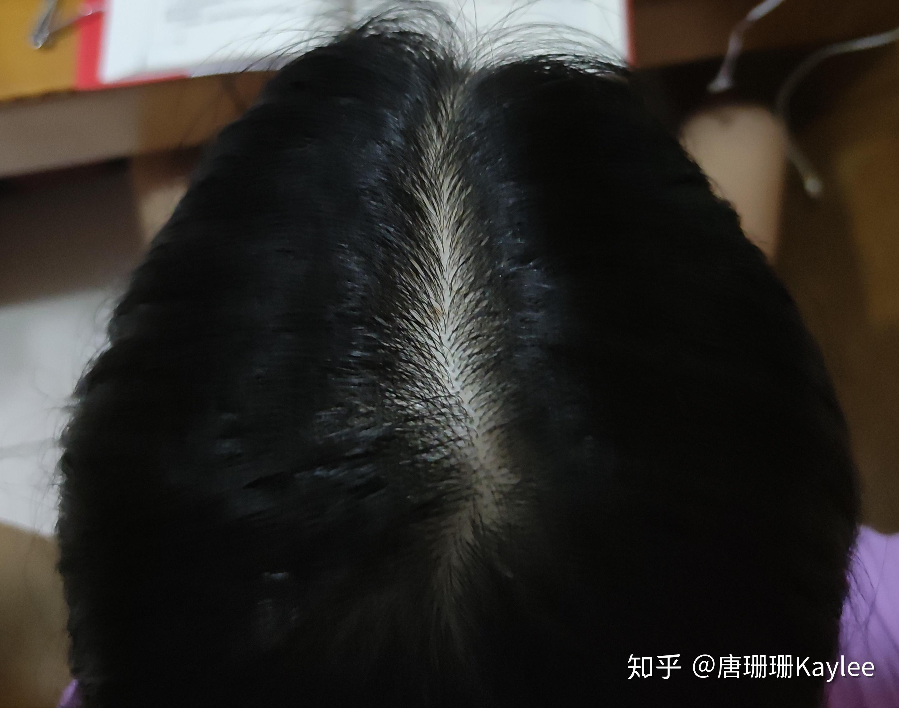 请帮看一下女生这样算秃顶吗