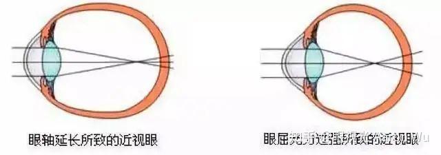 视力训练可以降低什么?是降低度数吗? - 知乎