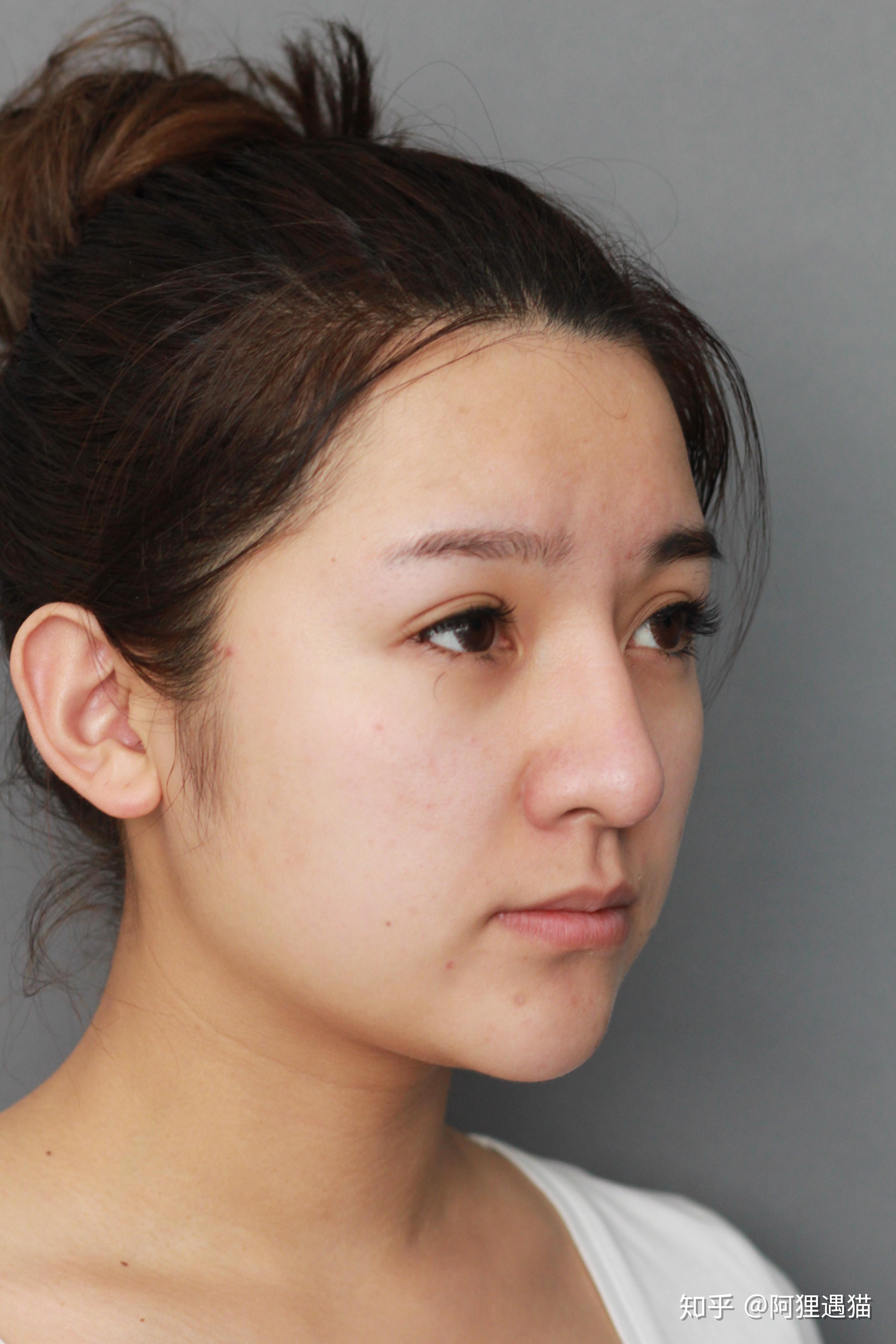 鼻子两侧的肉多怎么办