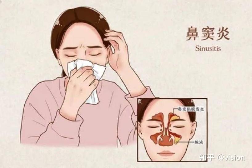 清鼻堂：鼻窦炎反复发作太难受，六个方法缓解鼻窦炎！ - 知乎