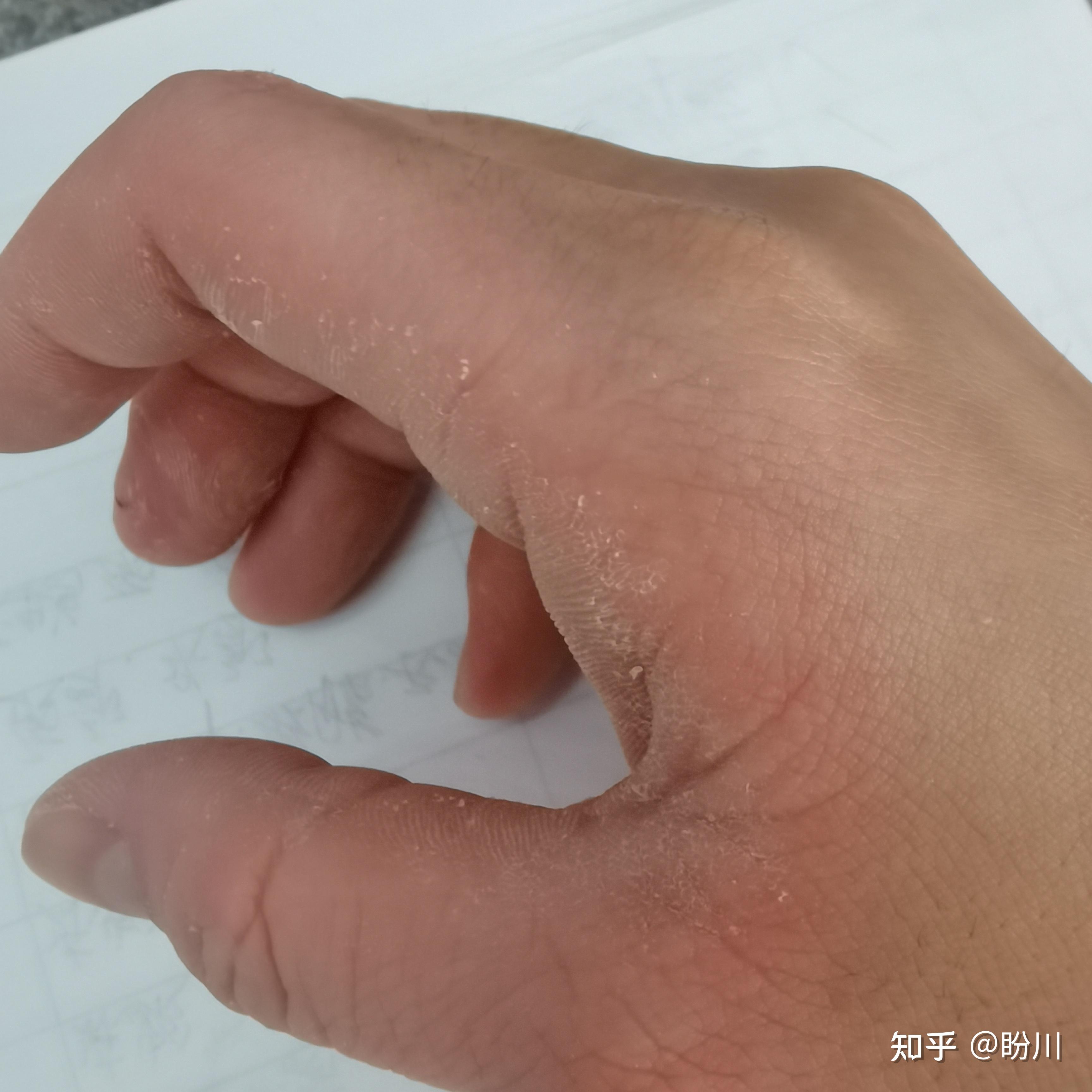 掌跖角化症有没有人成年以后慢慢缓解了的? - 知乎