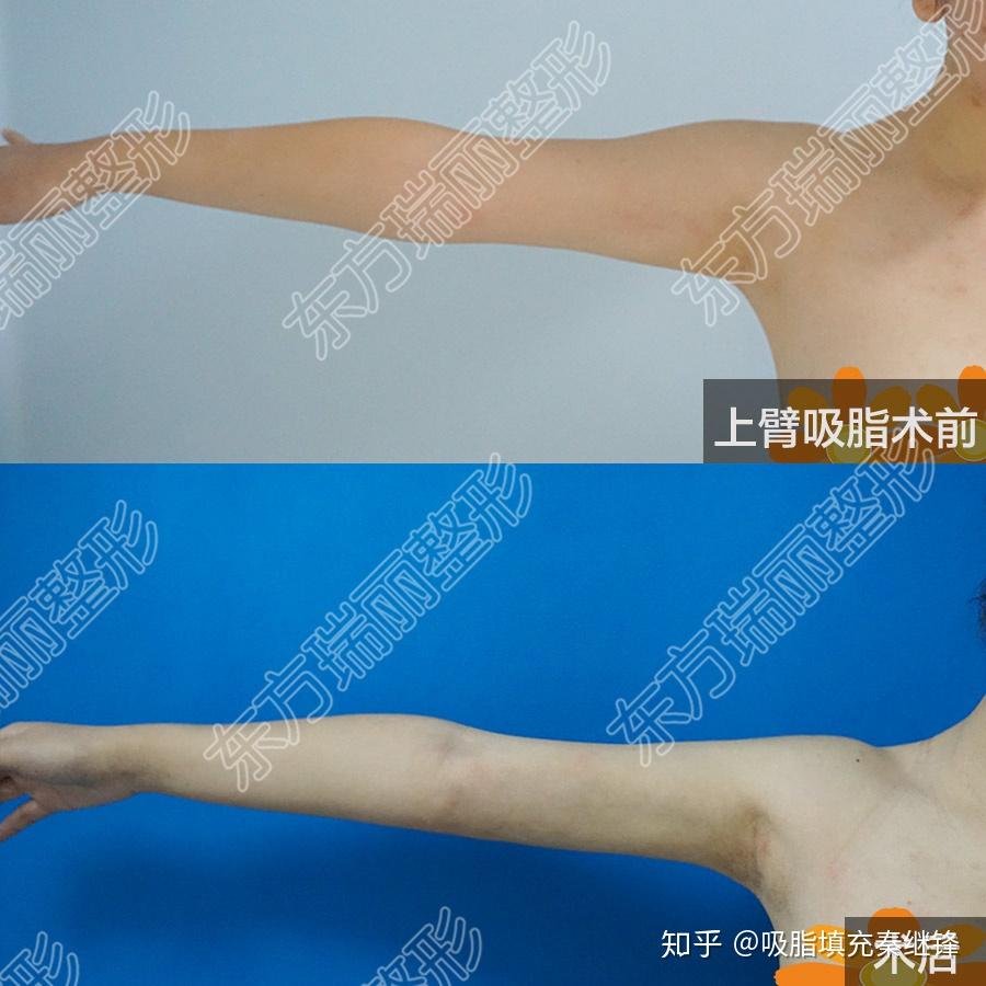 打溶脂针_打溶脂针进针多少_打溶脂针有技术吗