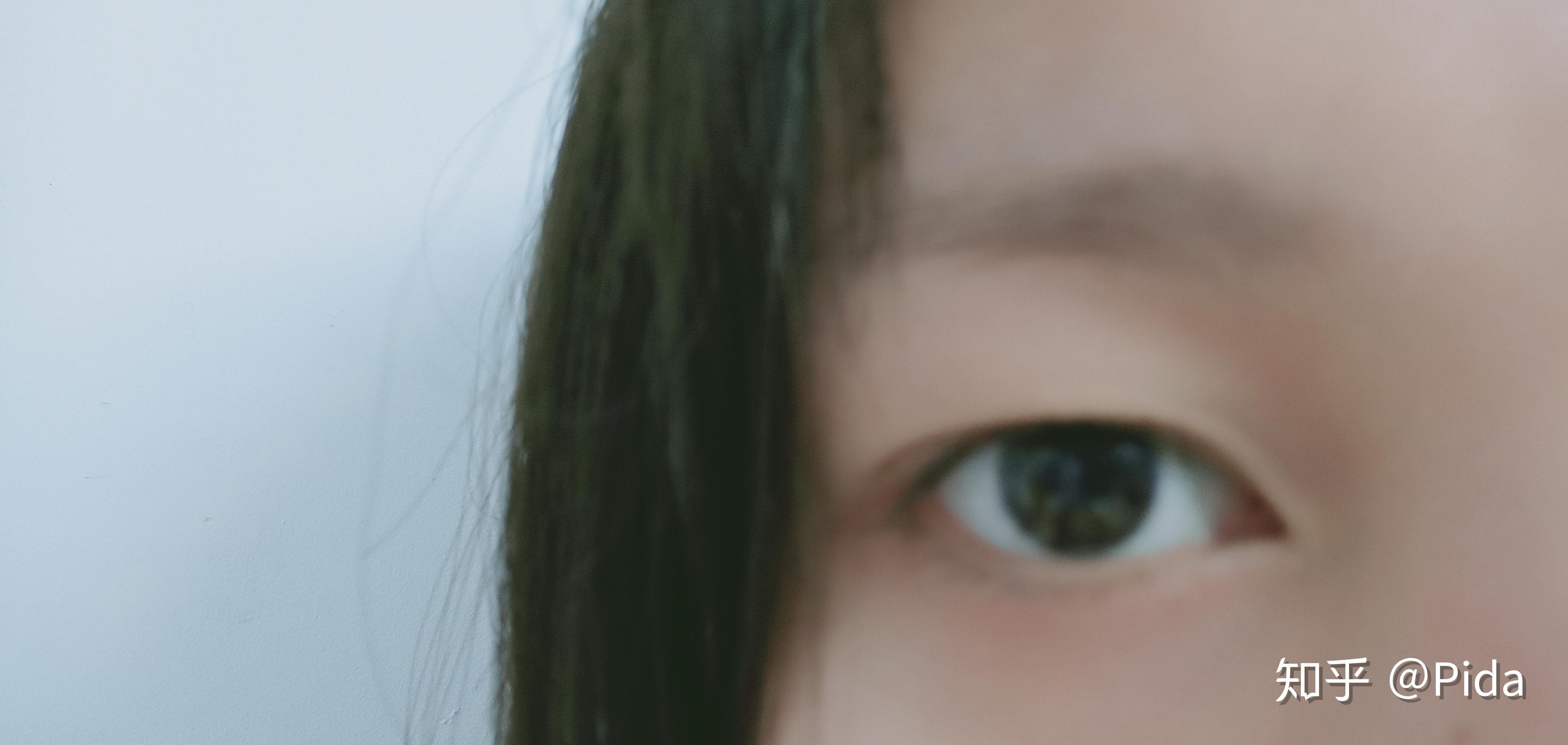 【双眼皮案例】切开双眼皮+开眼角 术后三个月效果分享 - 青岛新闻网