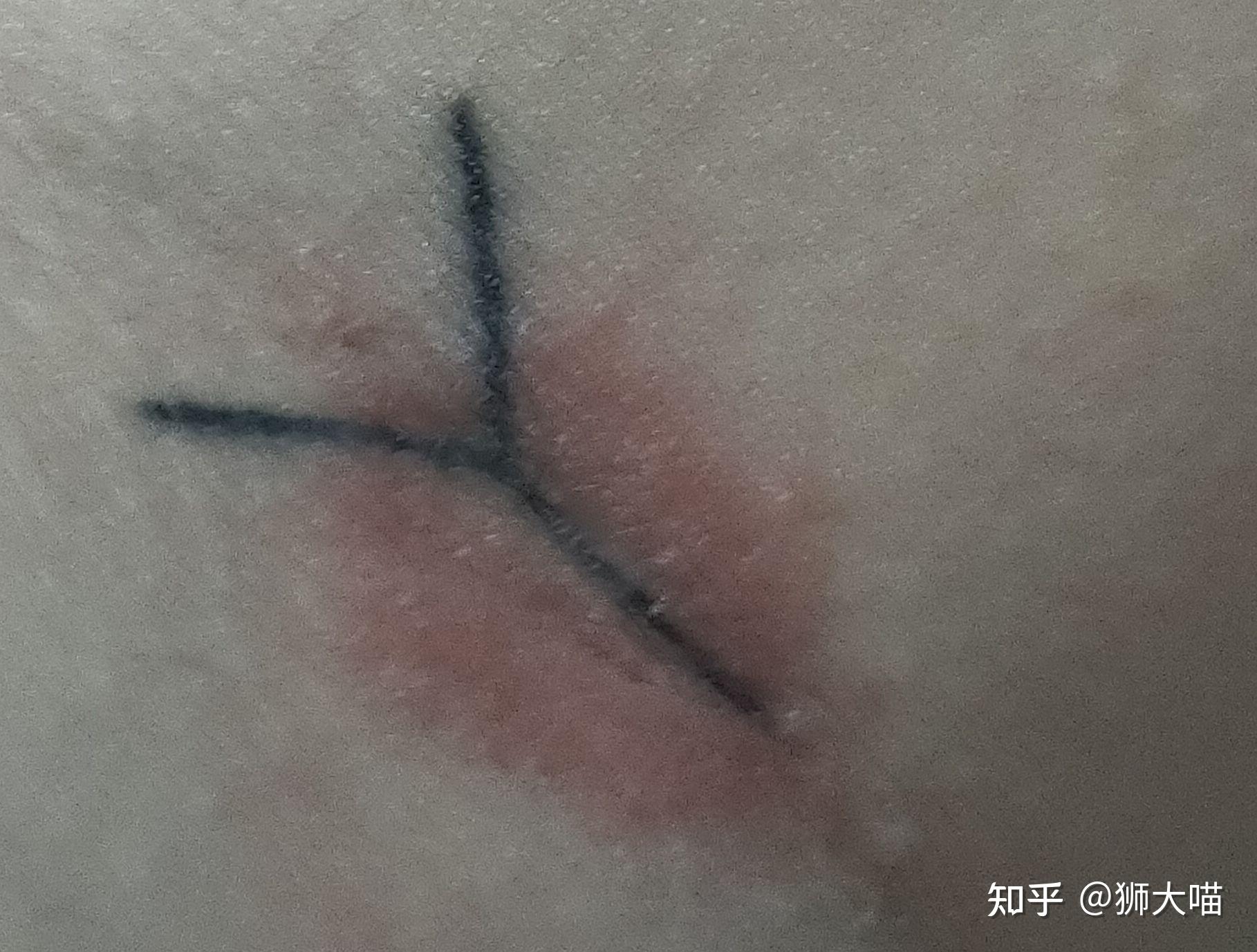 纹身一年多了最近又红又痒是过敏了吗