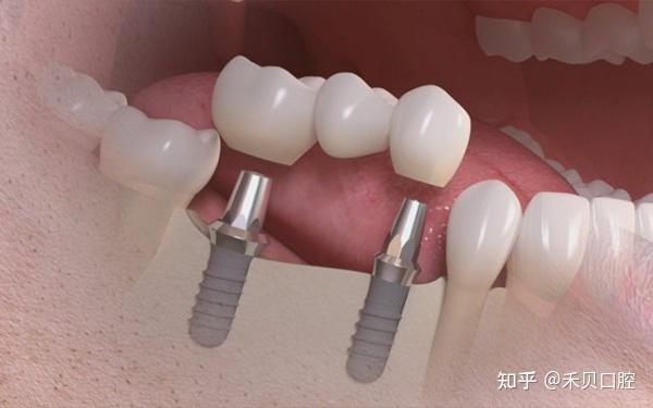 固定桥的分类!! - 知乎