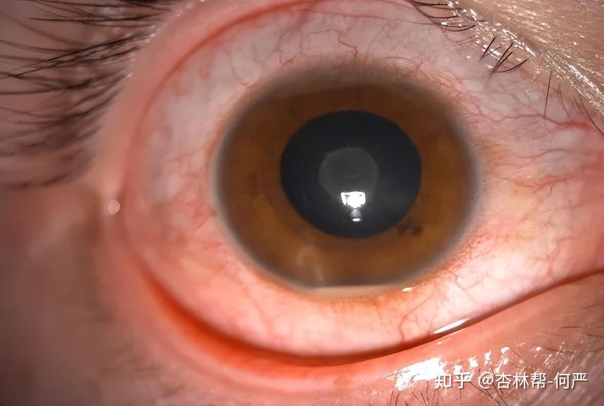 患有葡萄膜炎是一种什么感受? - 知乎