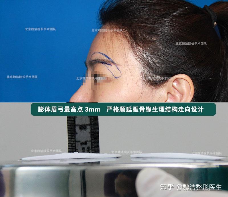 垫眉弓假体为什么要雕刻成弯曲的而非一字型直的 顺延眶骨骨缘生理走向 - 知乎
