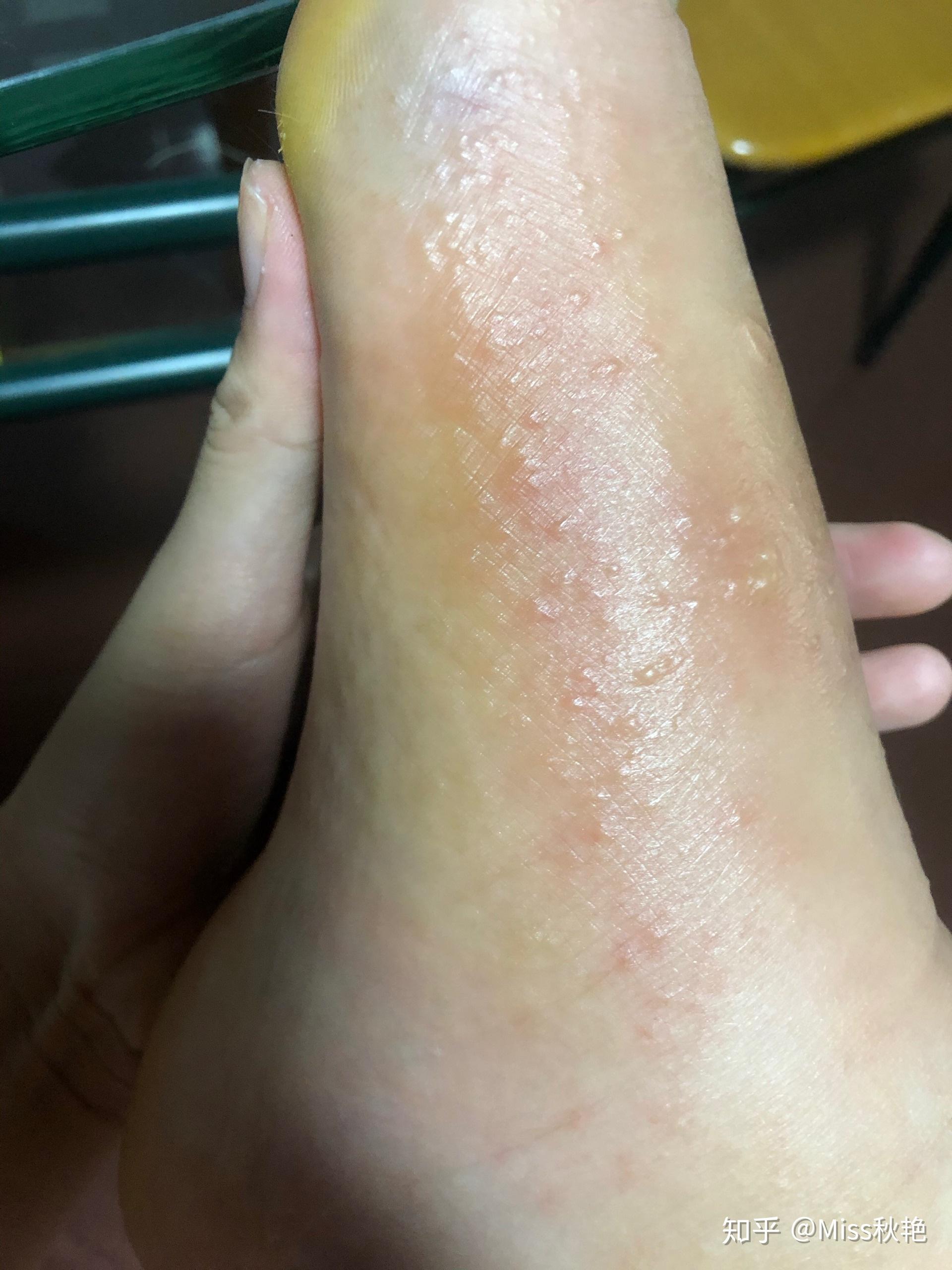 过敏会起水泡吗 知乎