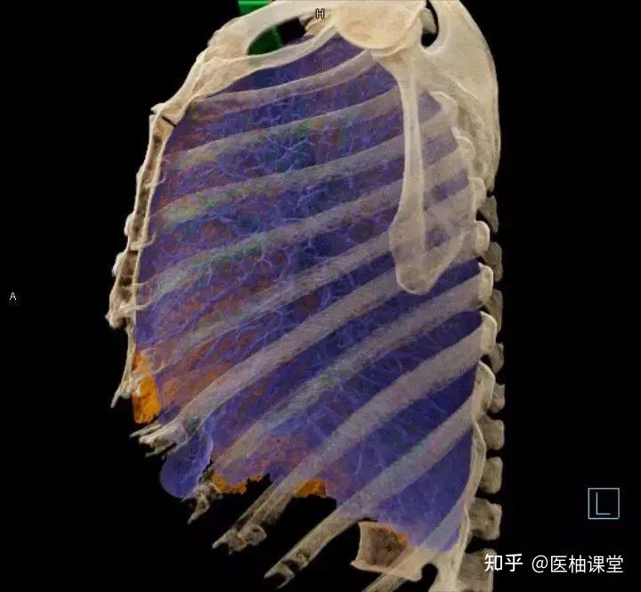 非常详细的肺部影像解剖 - 知乎