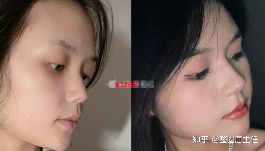 最近很火的濡白天使是什么?有什么功效?到底值不值得打? - 知乎