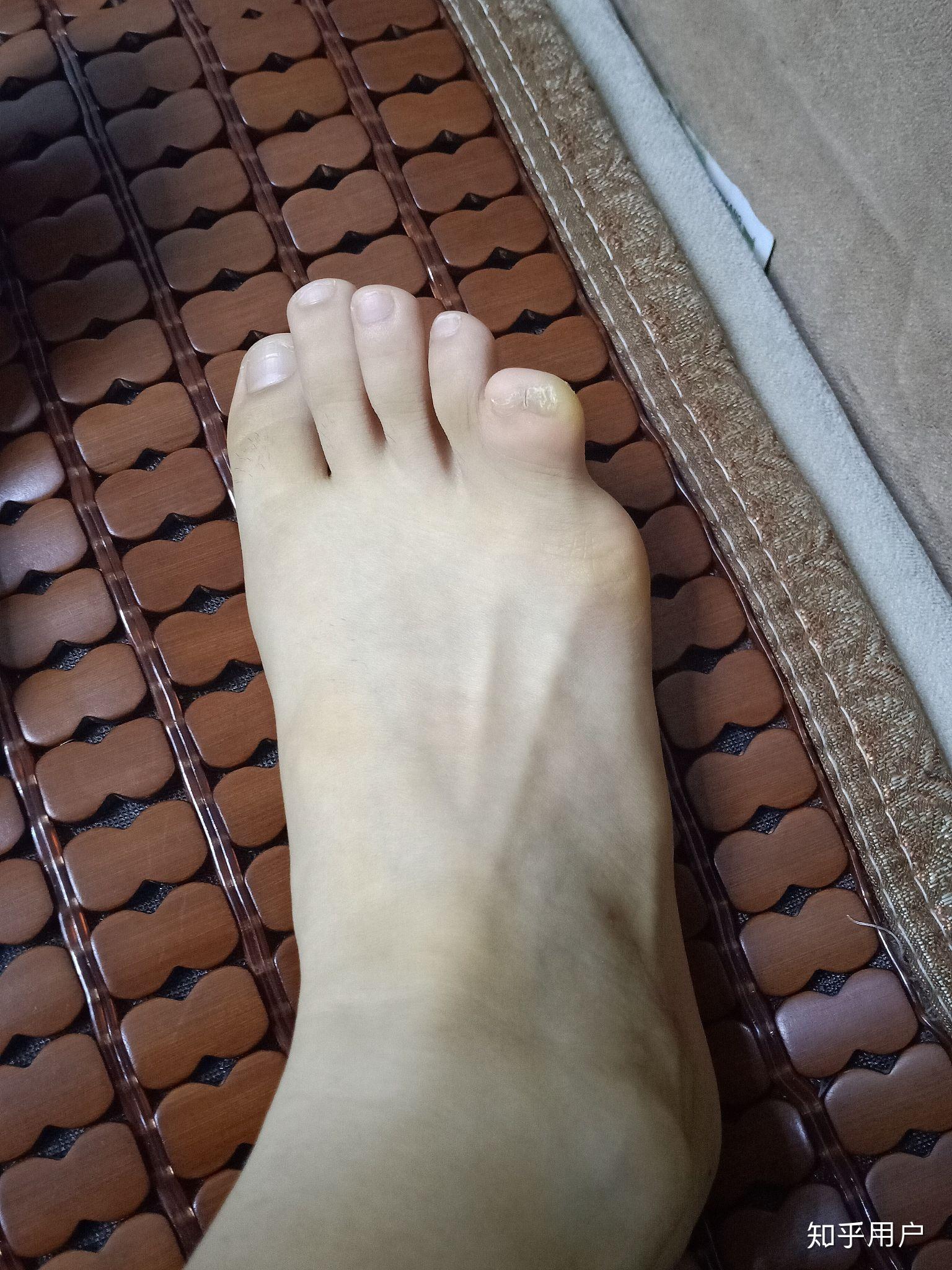 你们会介意女孩子脚趾畸形么? - 知乎