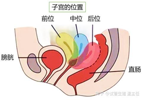 孕中期子宫位置示意图图片