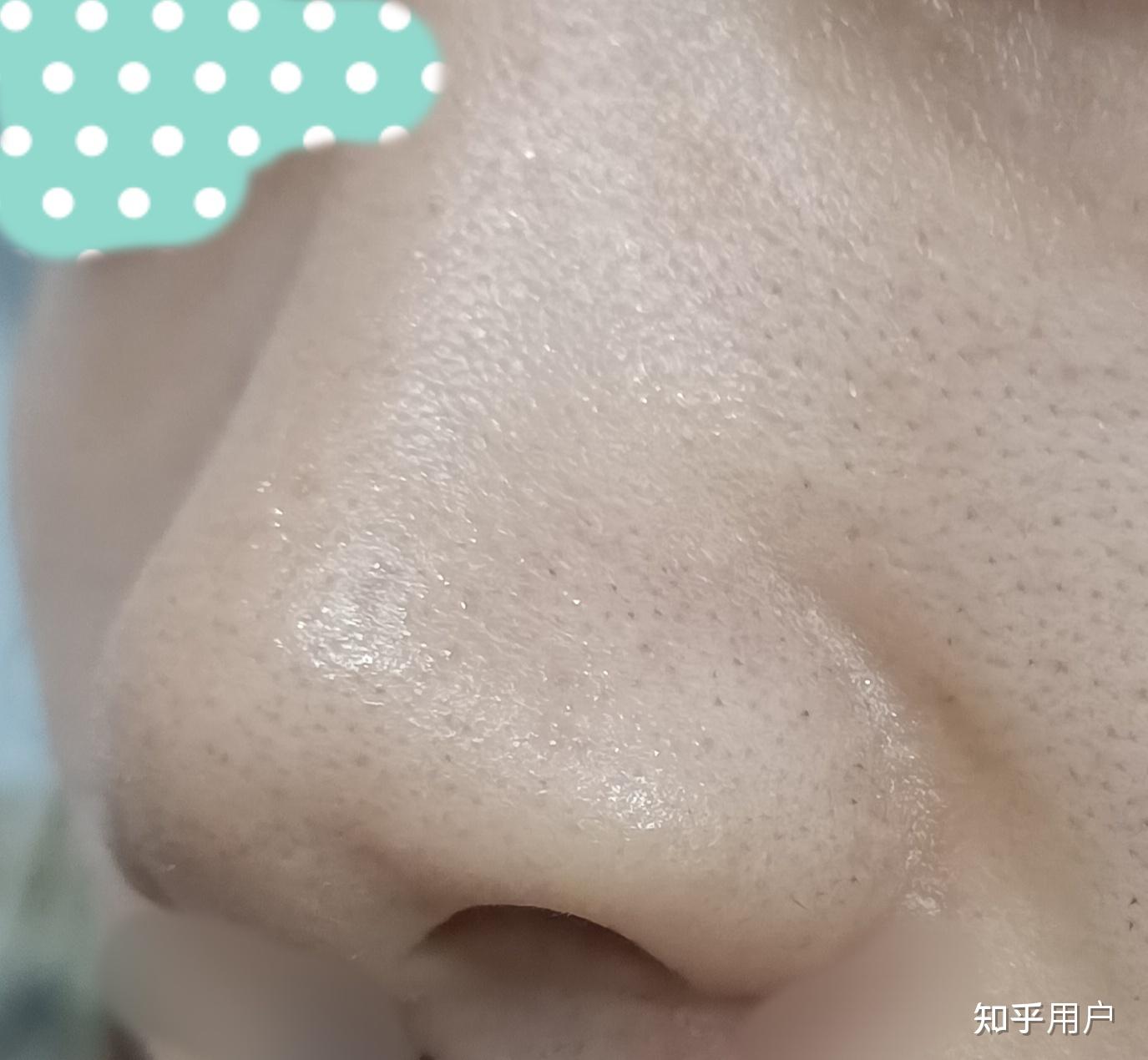 兄弟姐妹们,网上那个百分之15的壬二酸去黑头真有效果吗?