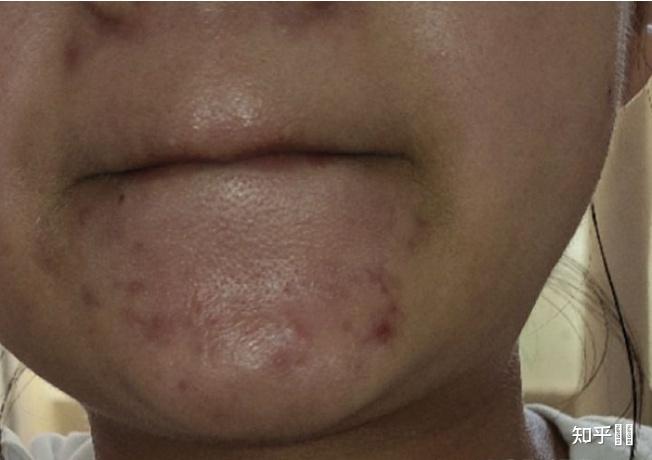 索尔祛痘真的有效吗?