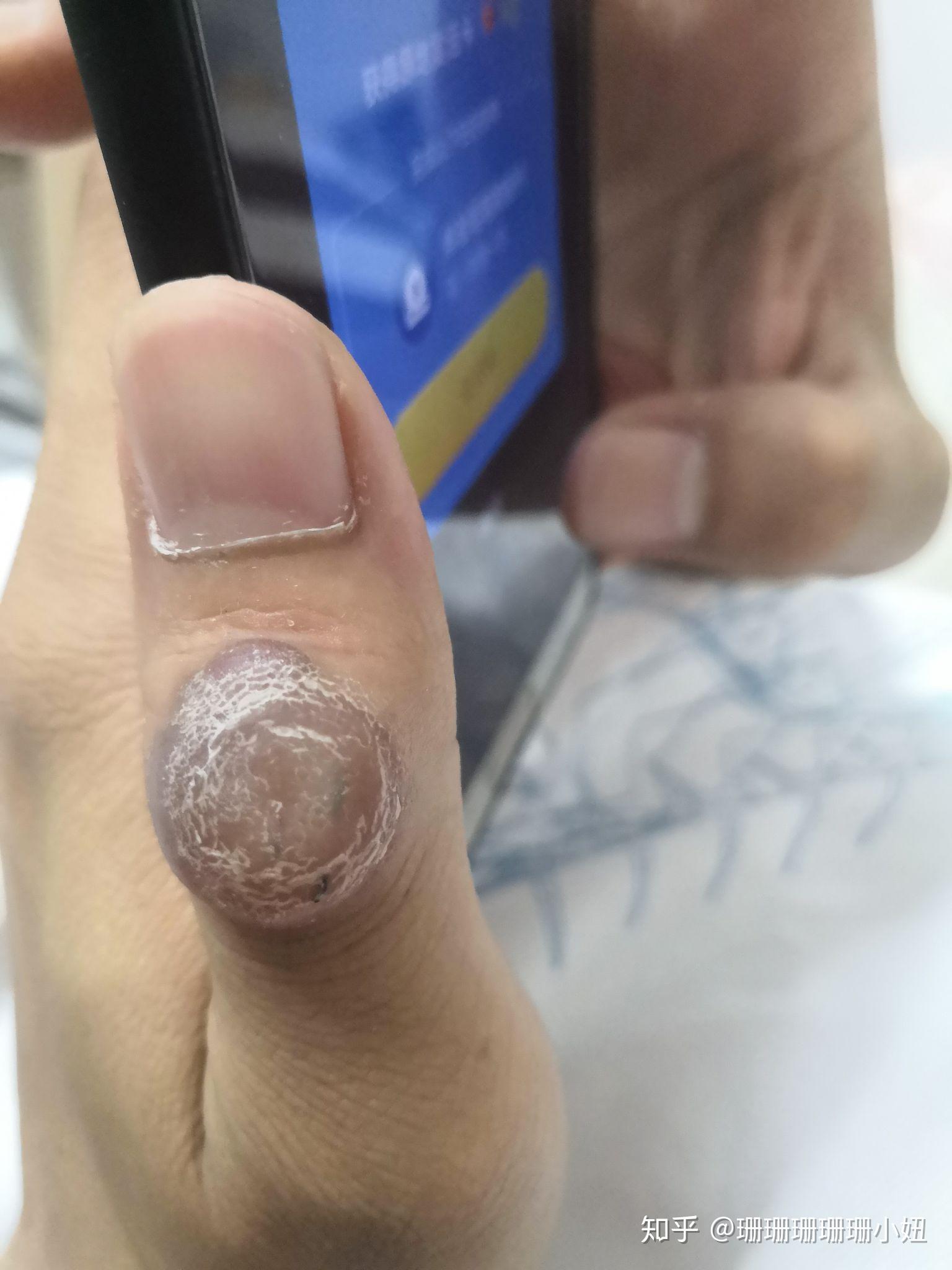 手部关节指垫怎么治疗?