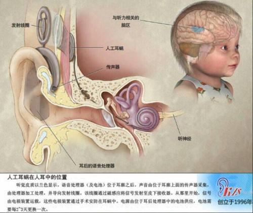 什么是人工耳蜗图片 v2-efe2cf73ee5b64361c2a99a60fdd8a01_1440w.jpg?source=172ae18b