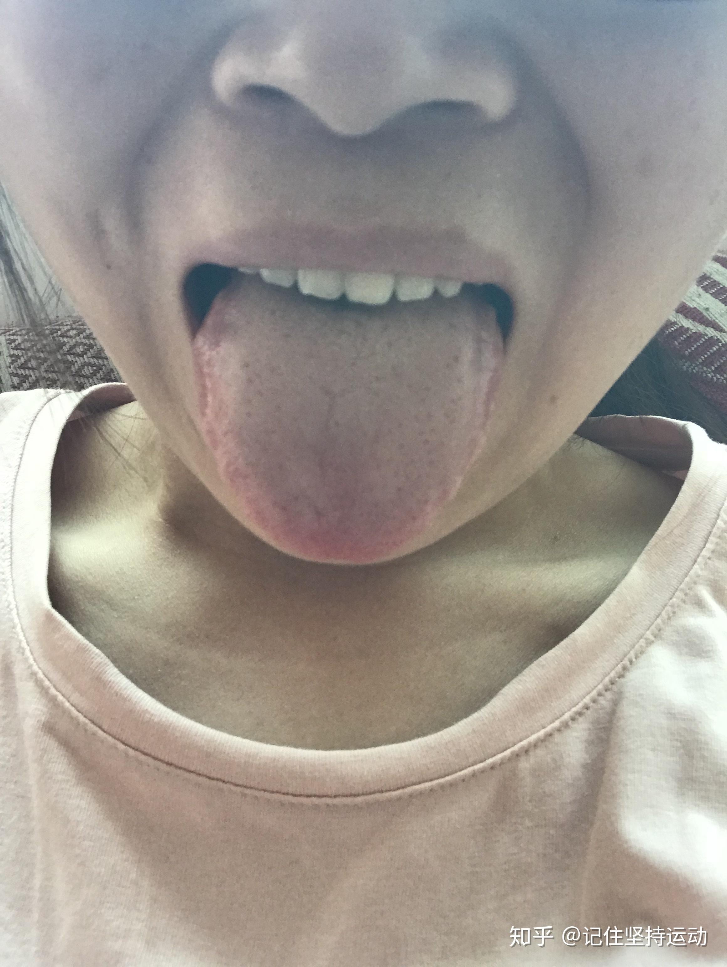 舌苔发黑是胃癌早期吗图片