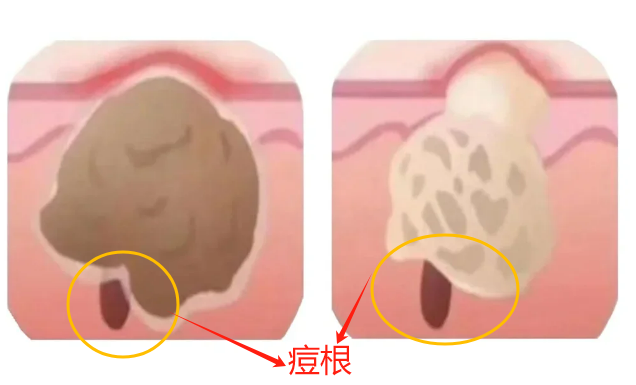如何在28天内把脸上的痘痘、痘印、痘坑去干净??盘点2025那些超好用的宝藏祛痘、祛痘印、填痘坑护肤品,用过的脸都好了!用错=烂脸!!! - 知乎
