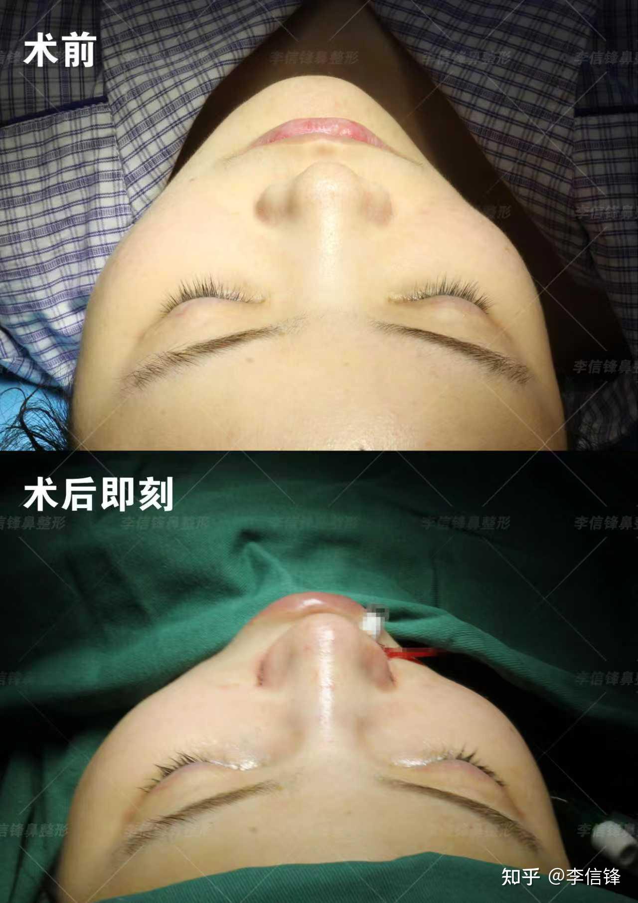 初鼻鼻综合-塌鼻、鼻头圆钝、漏鼻孔,鼻基底凹陷改善,术后即刻对比~ - 知乎