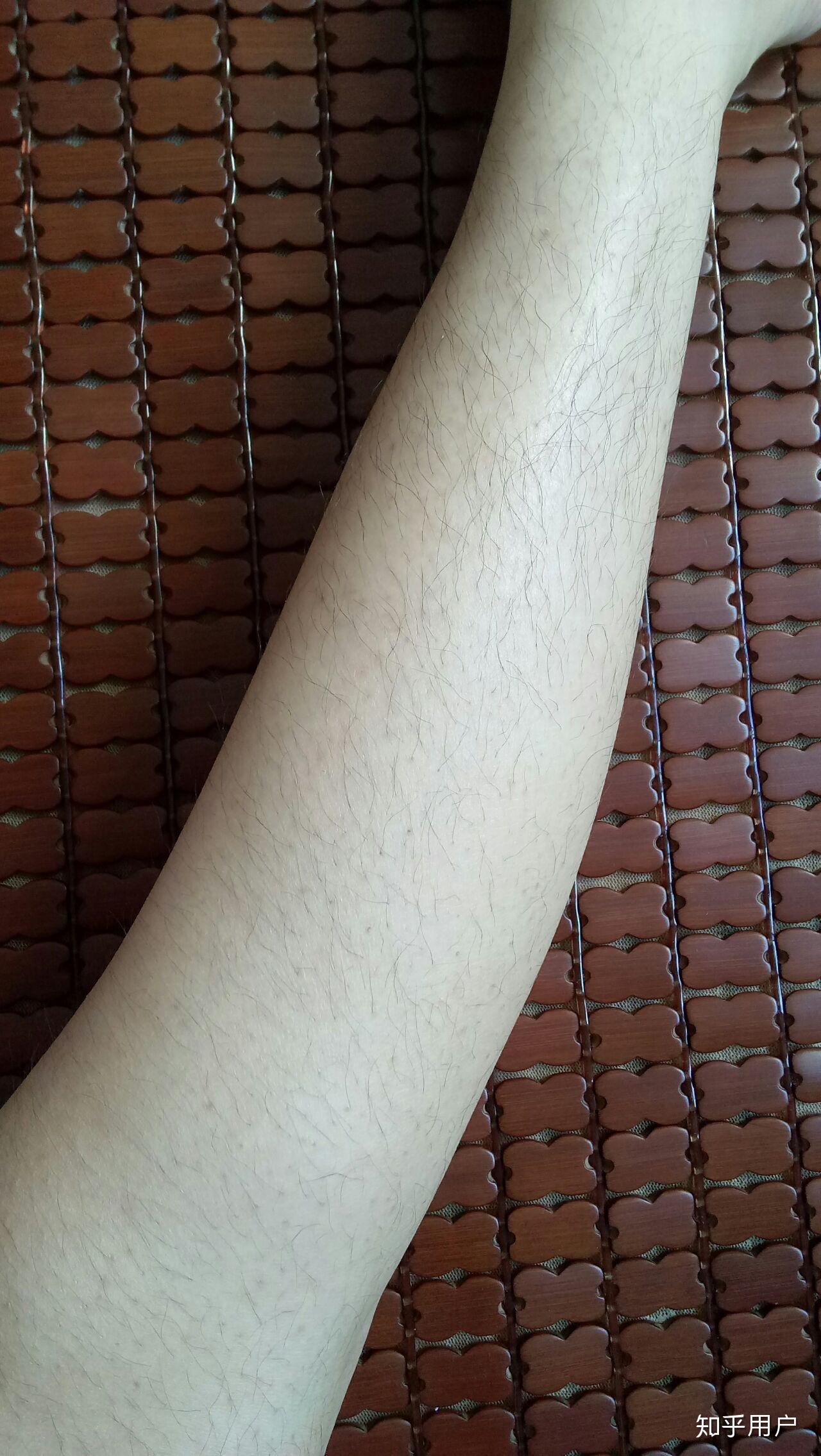 女生因为腿毛多活得很压抑怎么办