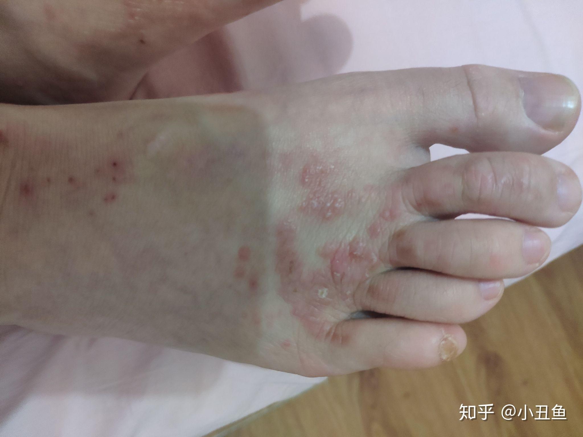 连续四年每到夏天双脚脚面就犯湿疹有没有办法根治