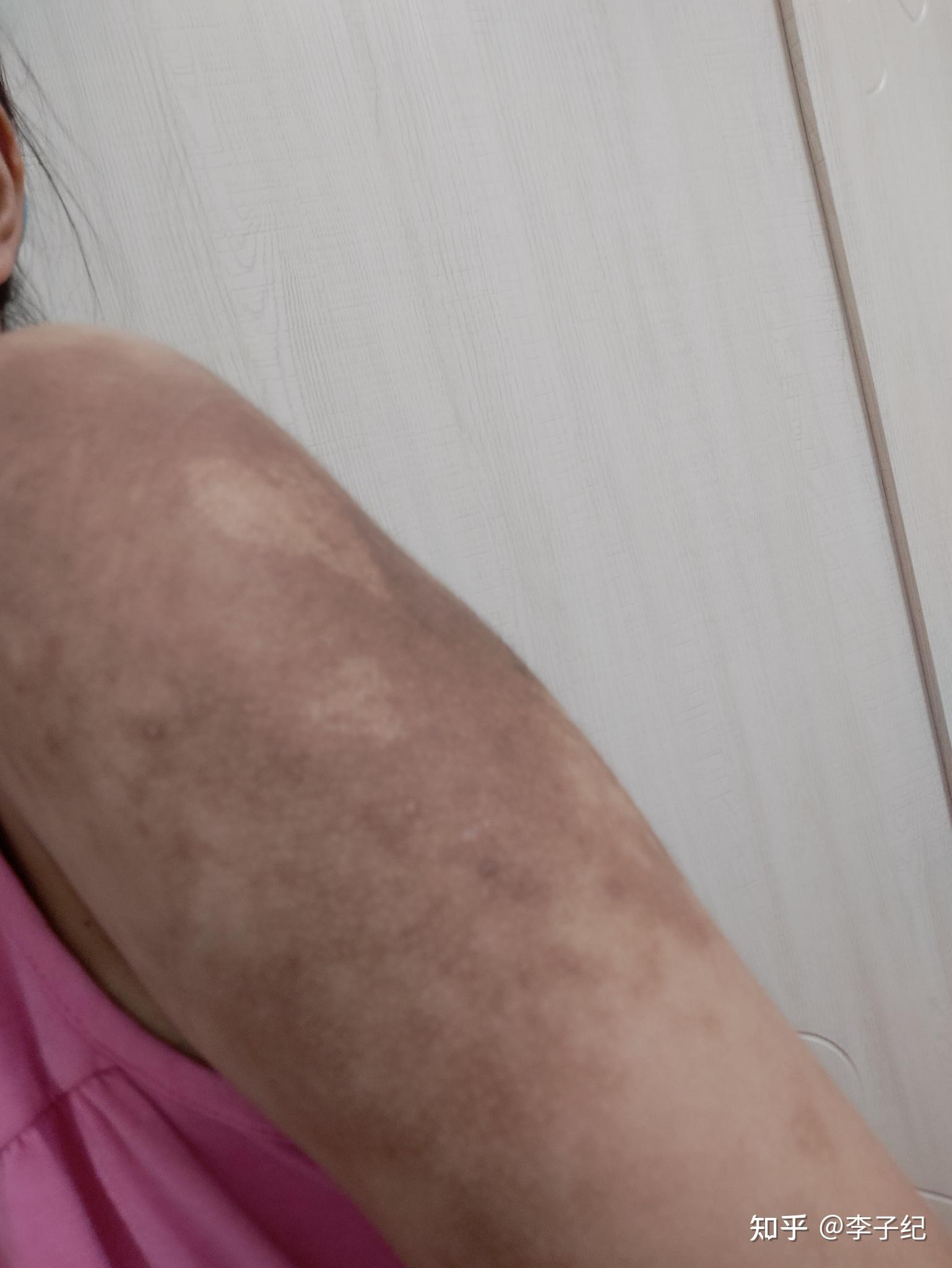 色素性毛表皮痣是一种怎样的病能否治愈