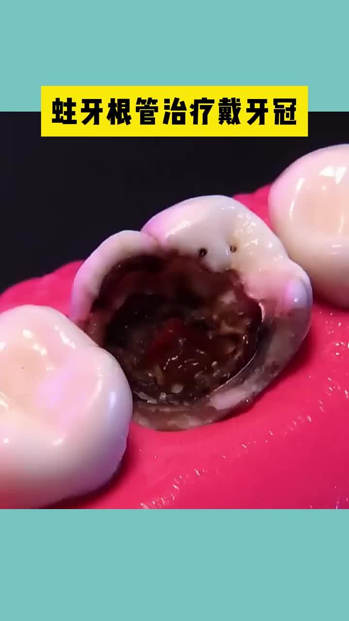 蛀牙根管治疗戴牙冠过程