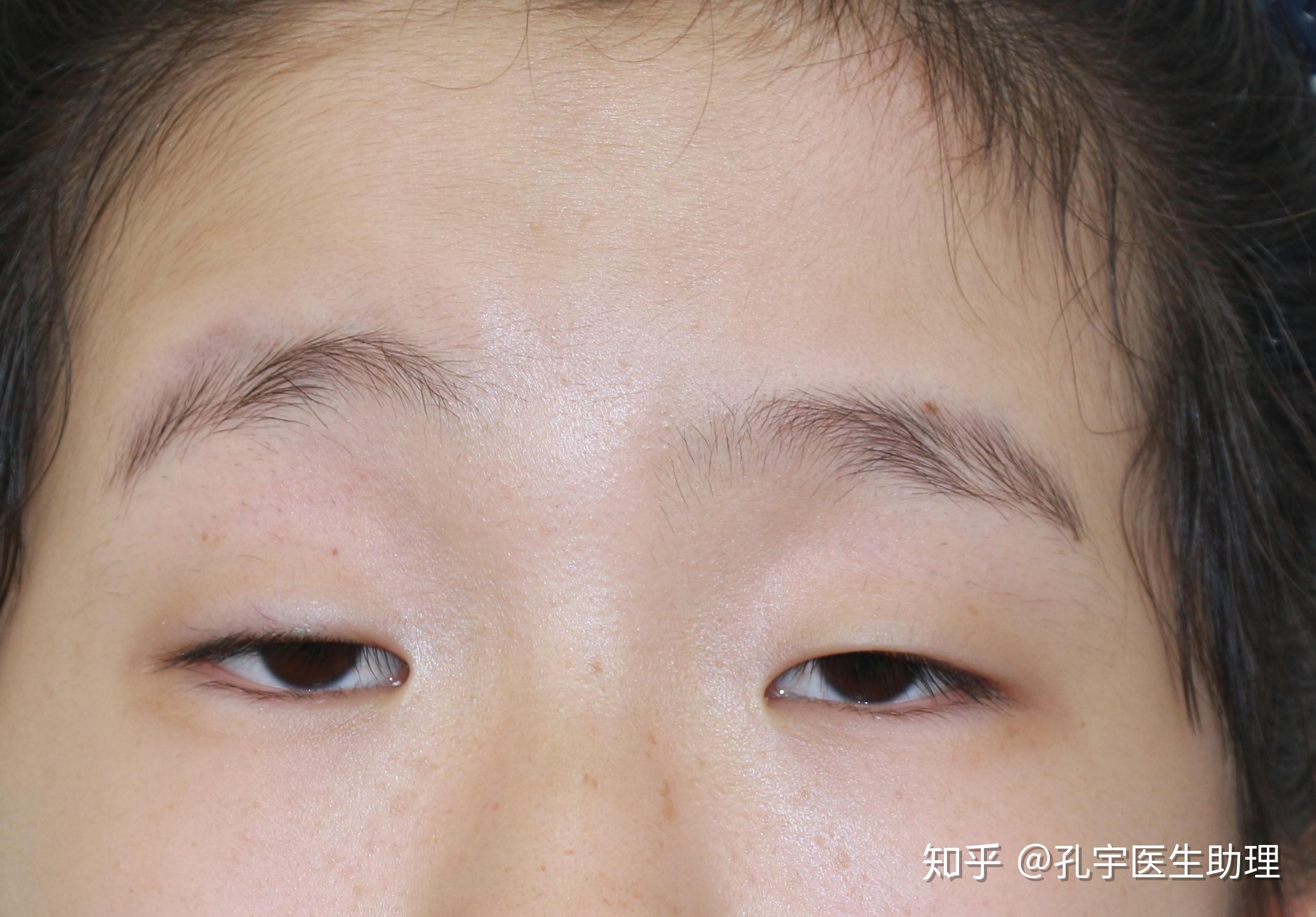 天生的小眼睛,请问这种眼睛应该怎么拯救? - 知乎
