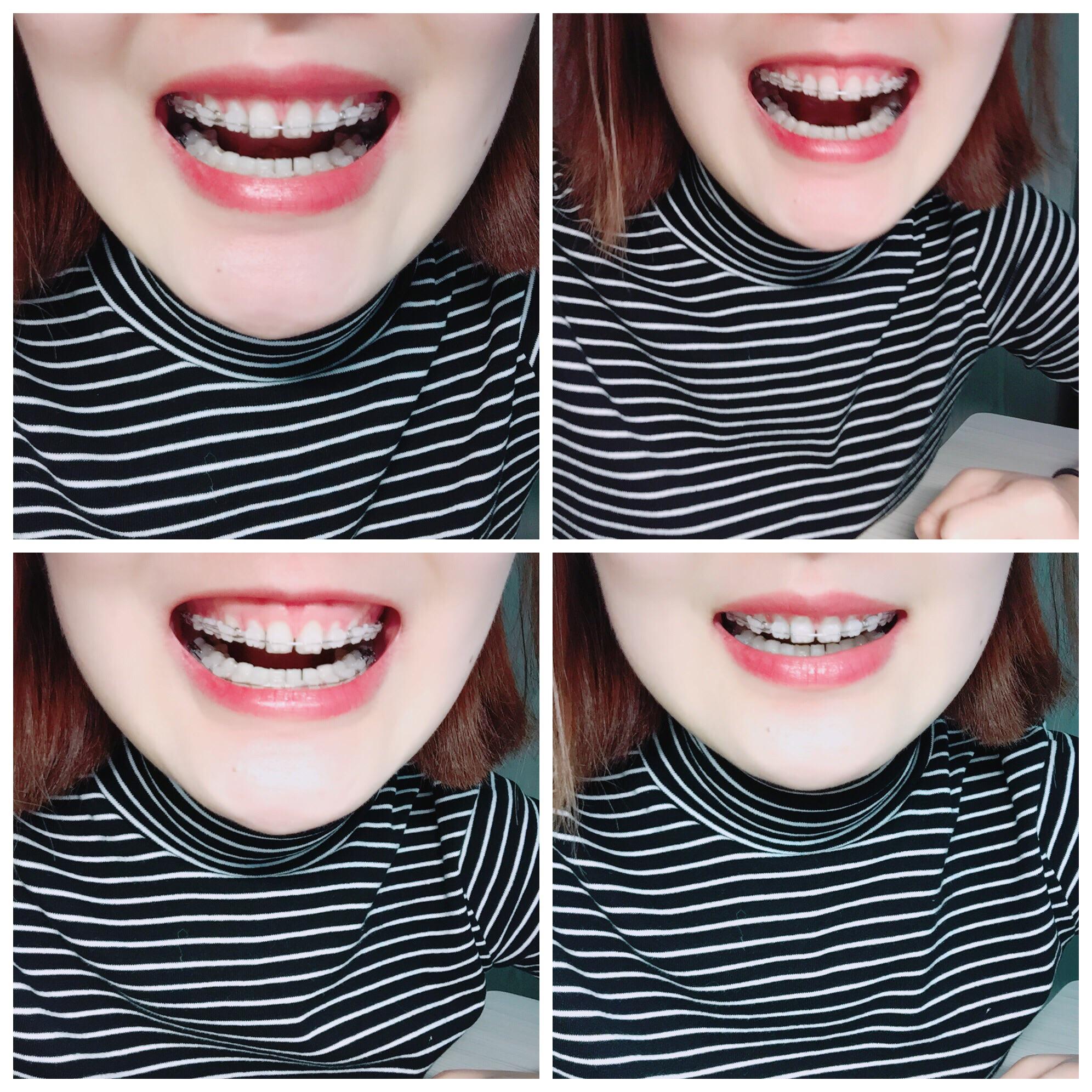 女生矫正牙齿是怎样一种体验