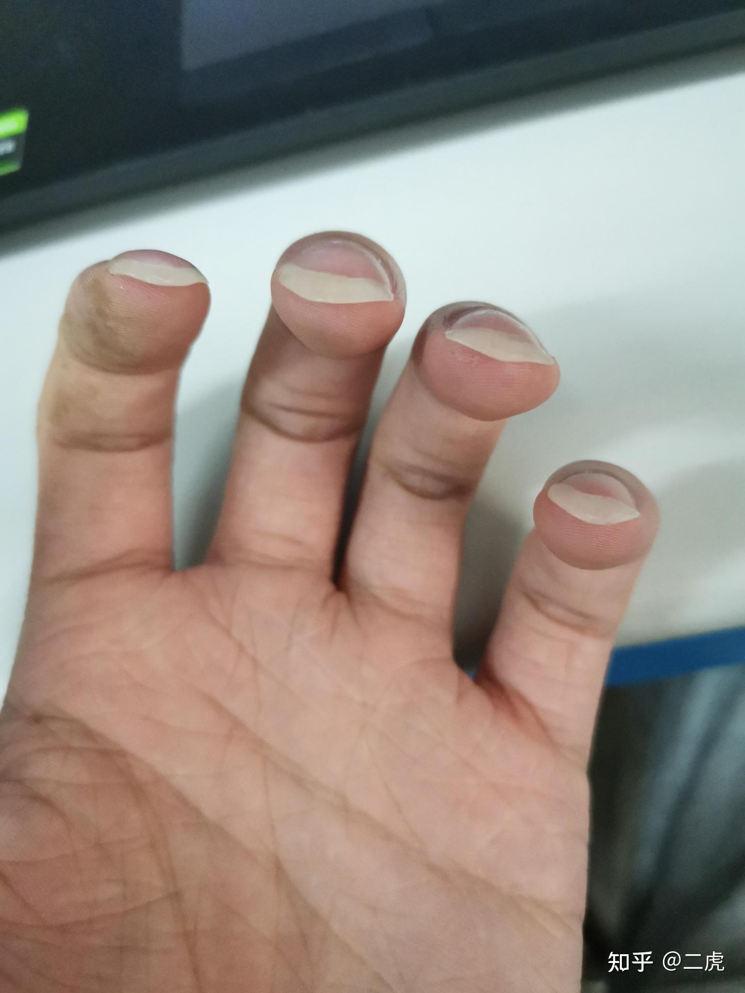指甲长出的一半向下弯曲是什么情况? - 知乎