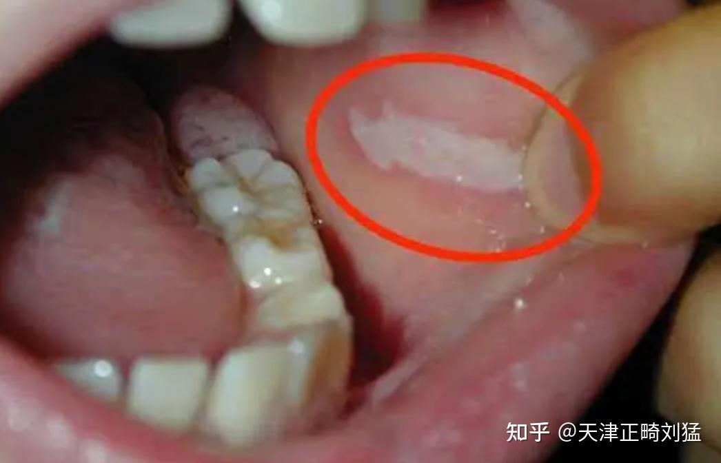 总喜欢用牙齿咬腮帮里的肉,是咬颊症吗?