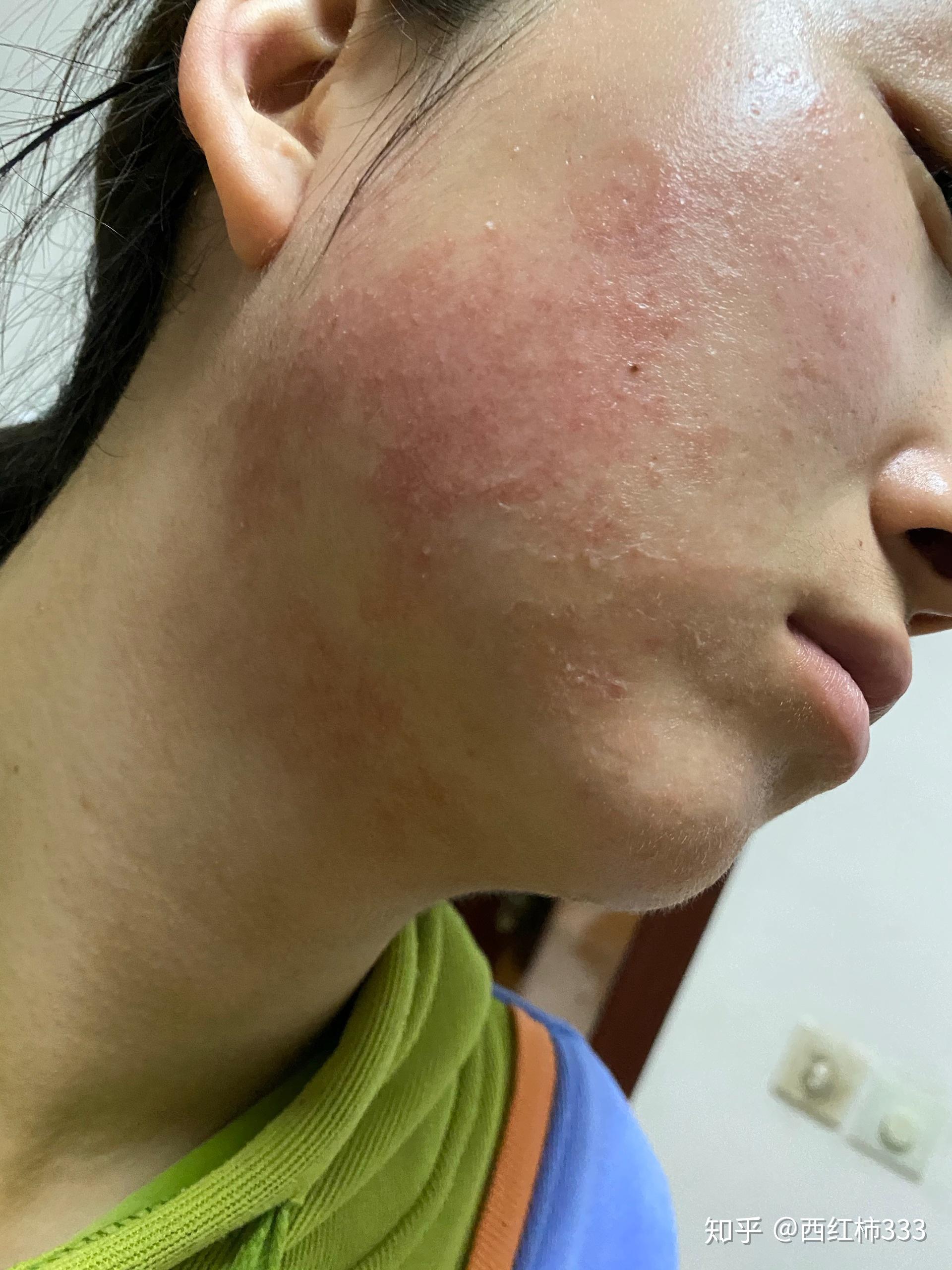 用了丽点维a酸和尿素维e乳膏,用了两天,脸上就这样了,求问医生朋友这