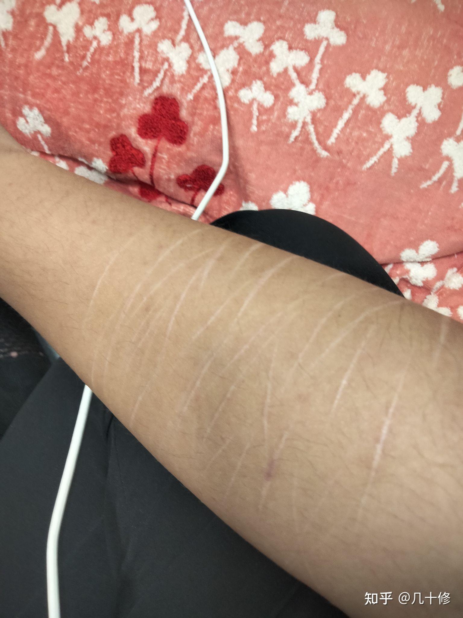 自残过有伤疤的人被看到会被歧视吗?