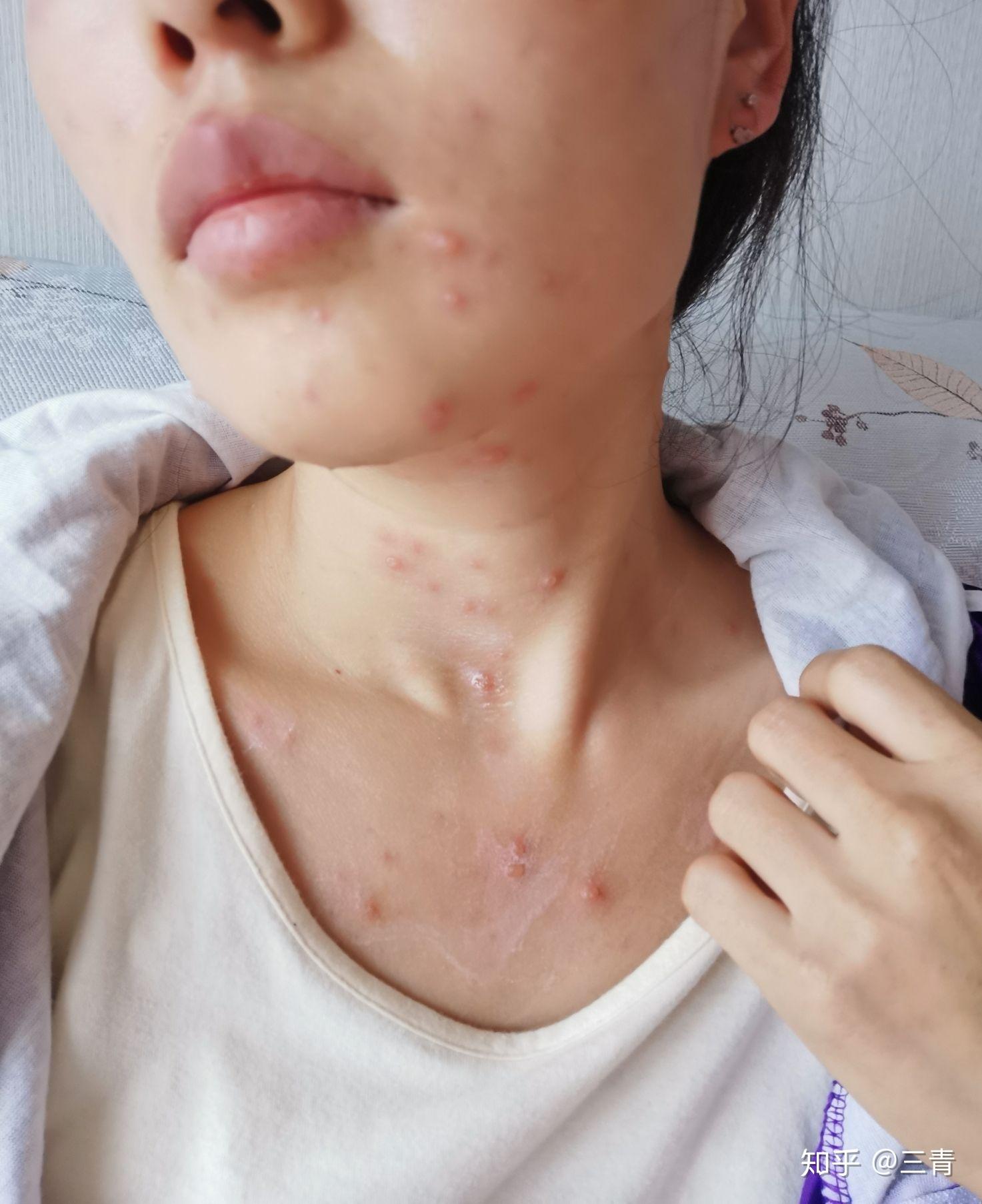 成人长水痘是什么样的经历