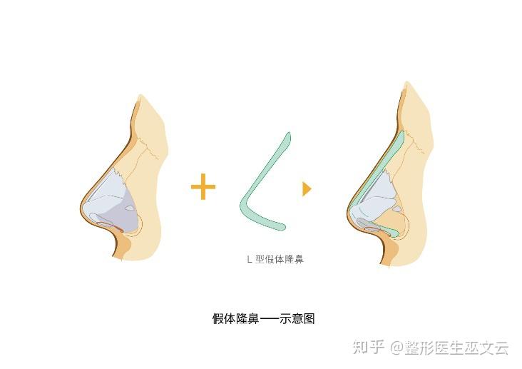 鼻综合属于几级手术
