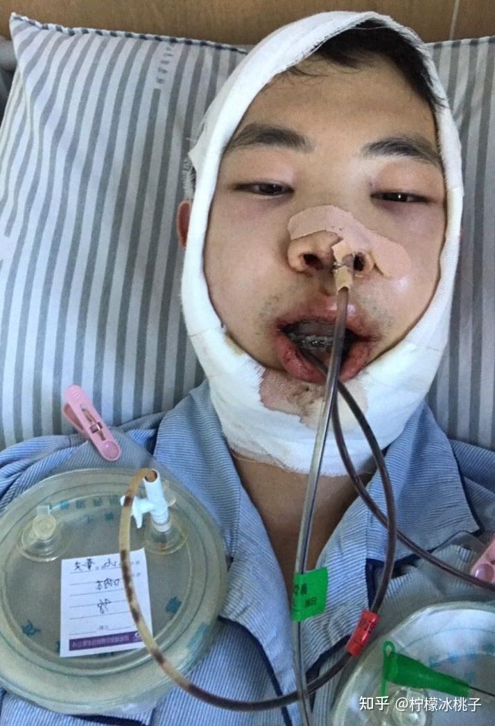正颌手术失败的你现在怎样了