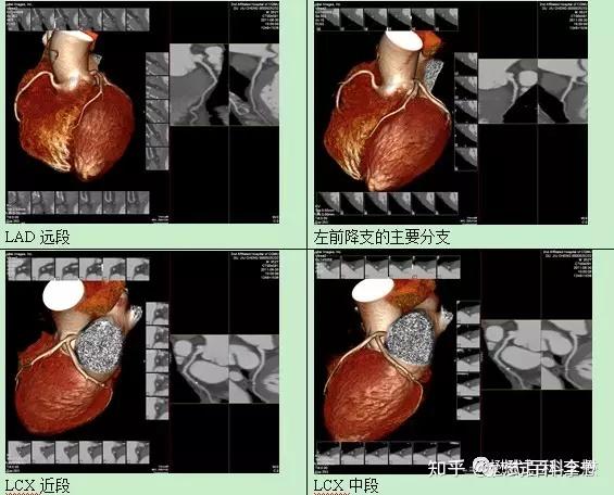 常用的CT图像重建技术及后处理 - 知乎