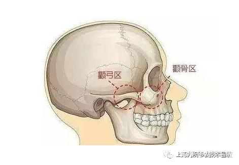 九院韦敏 | 颧弓颧骨对颜面部的作用 - 知乎