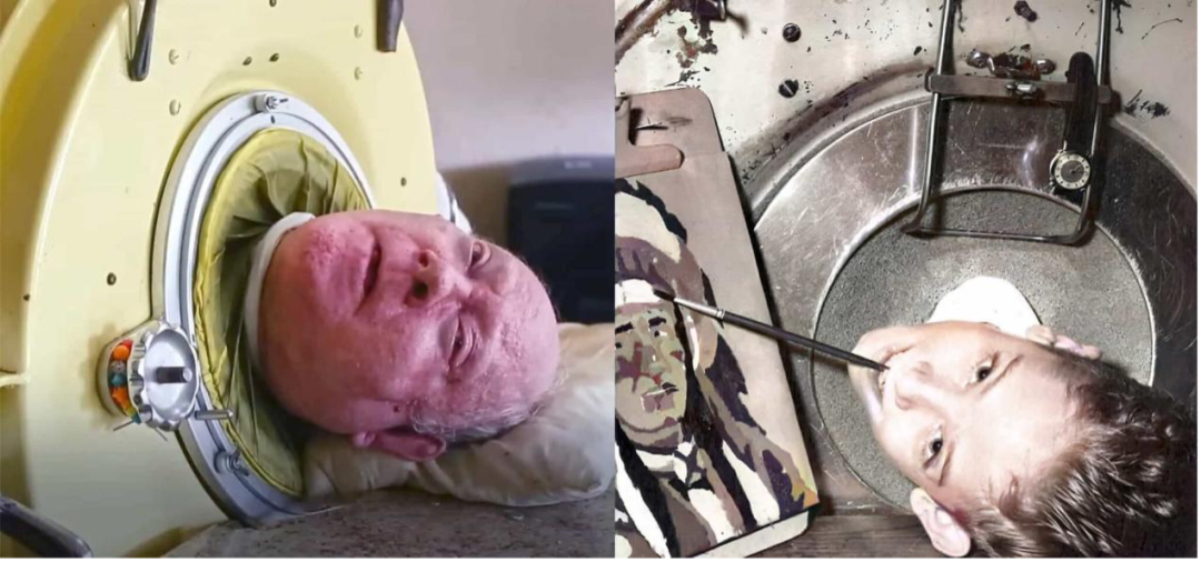 美国77岁男子靠铁肺生活70年如何从医学角度解读该情况