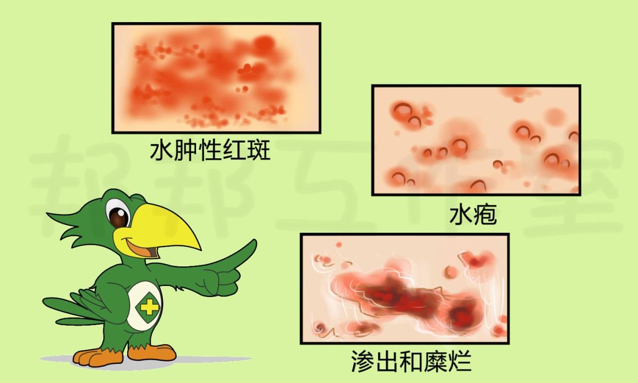 如何评价皮肤“光过敏”、“紫外线过敏” - 知乎