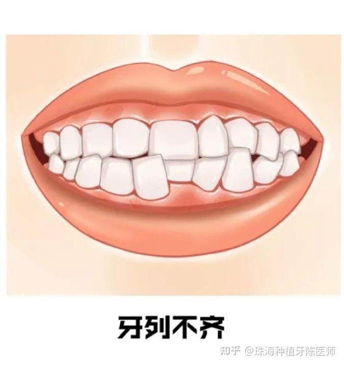 一分钟教你了解牙齿的常见畸形问题 - 知乎