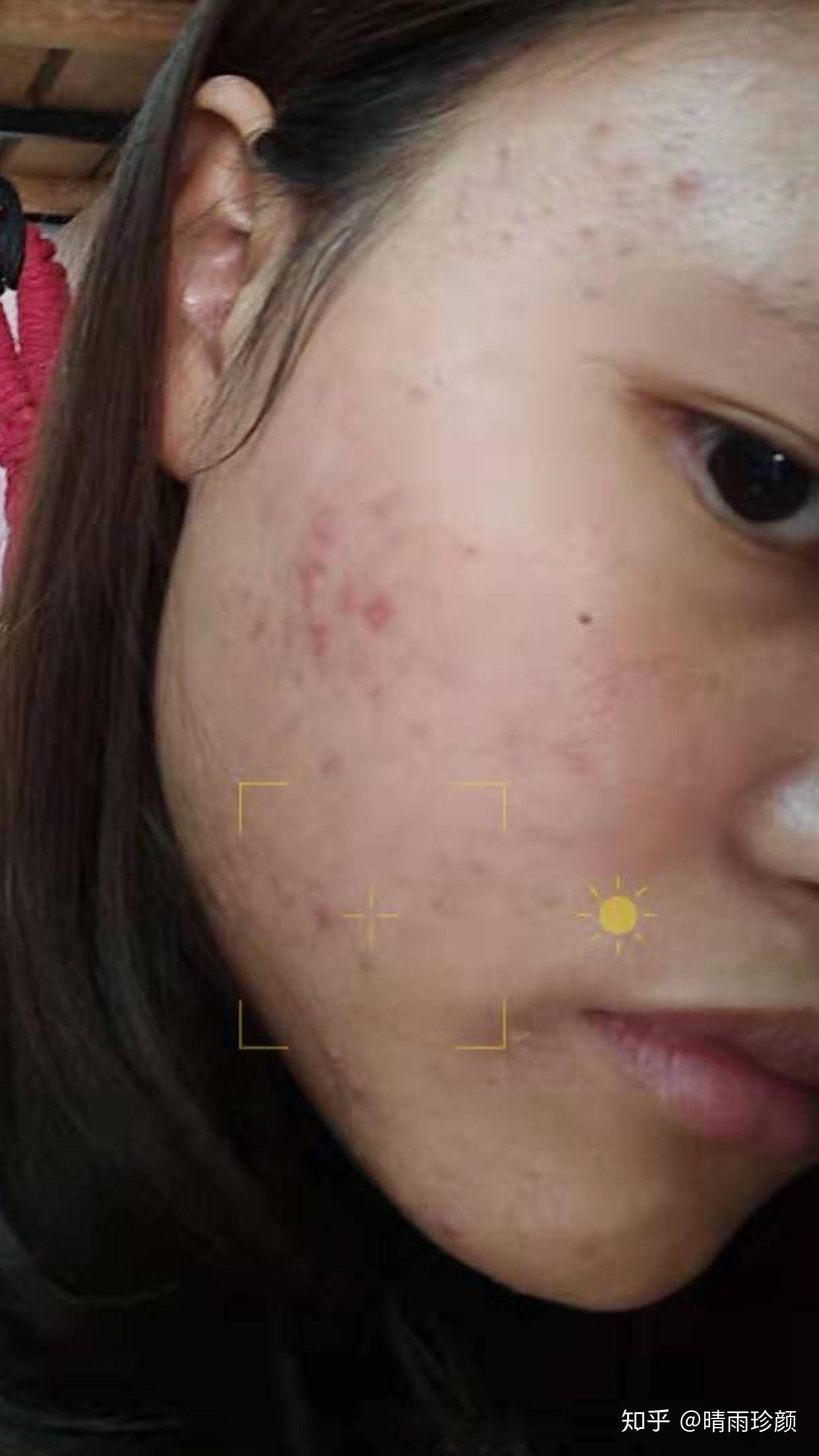 丘疹型痘痘要多久才能自愈? - 知乎