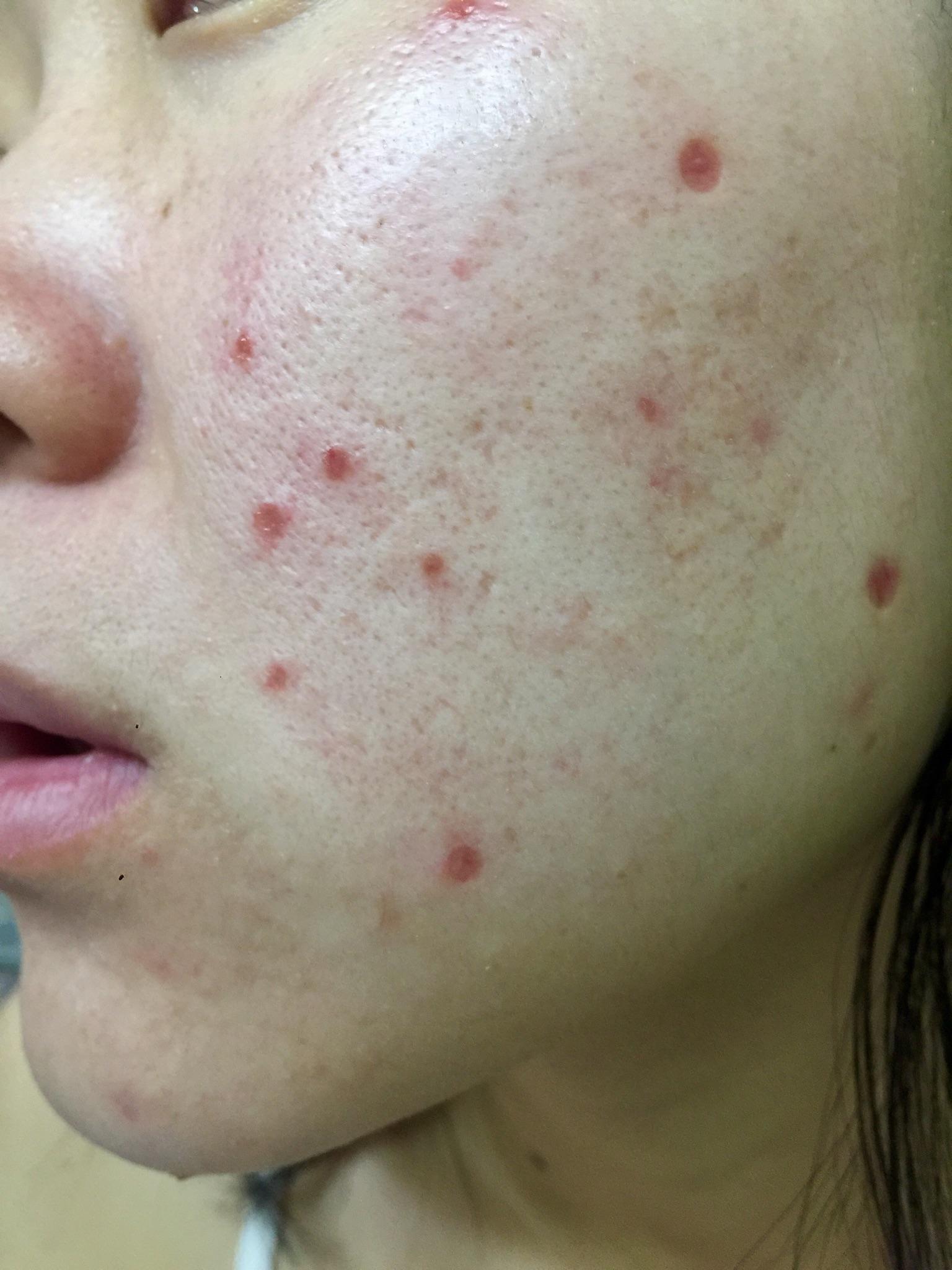 点完痣了 有一个黄豆大的坑 脸上 请教如何避免疤? - 知乎