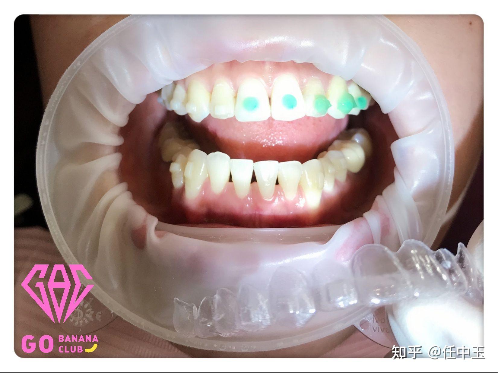 带隐形牙套为什么要粘白色的小附件