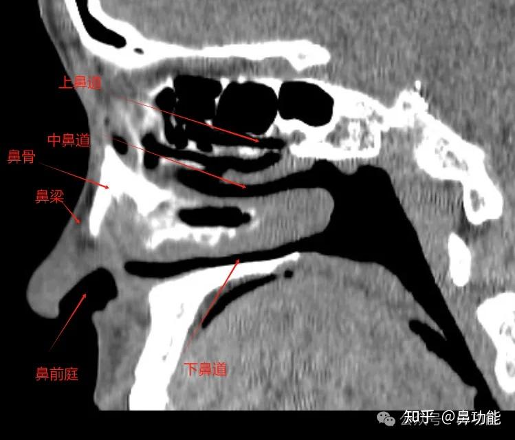 鼻窦 CT 各部位名称解析与鼻腔解剖基础知识 - 知乎